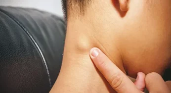 Kenali Tanda-Tanda Fisik Kanker Getah Bening Sebelum Terlambat